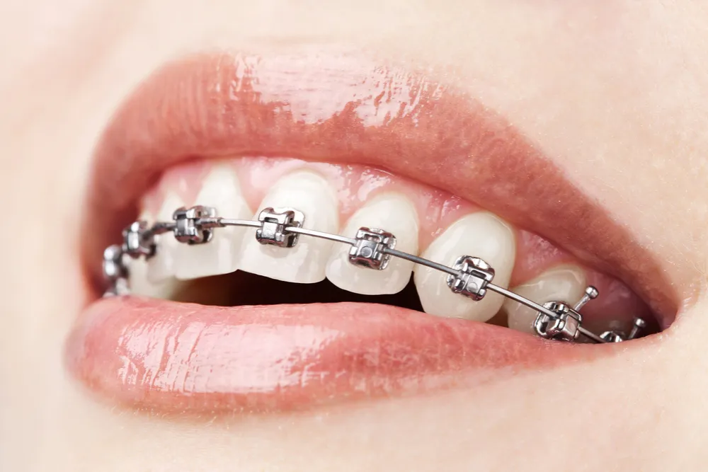 Orthodontics Braces 